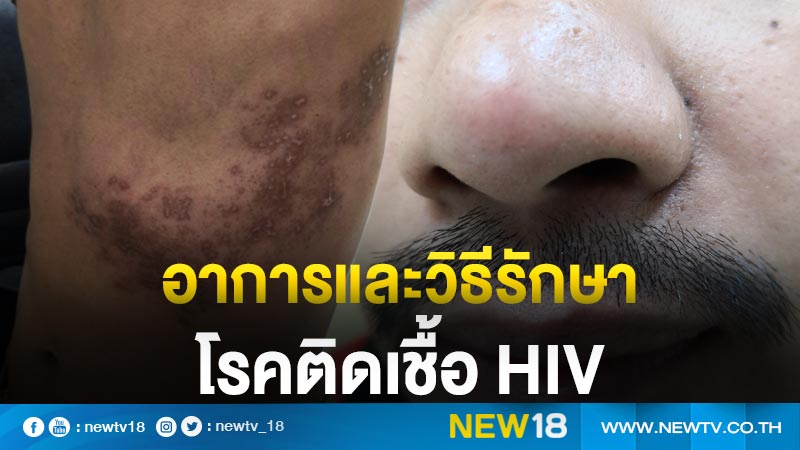 อาการและวิธีรักษาโรคติดเชื้อ HIV 