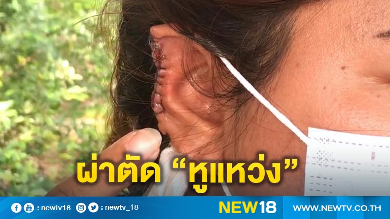 สาวโวยหมอ! ผ่าตัด “เนื้องอกใบหู” แต่กลับตัด “หูแหว่ง”