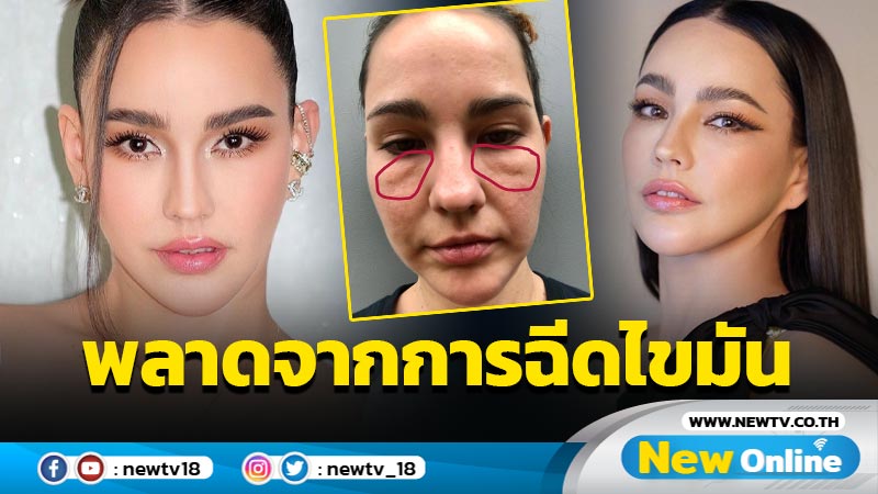 “แหม่ม วิชุดา” เปิดภาพแชร์อุทาหรณ์ หลังเกิดความผิดพลาดจากการฉีดไขมันใต้ตา