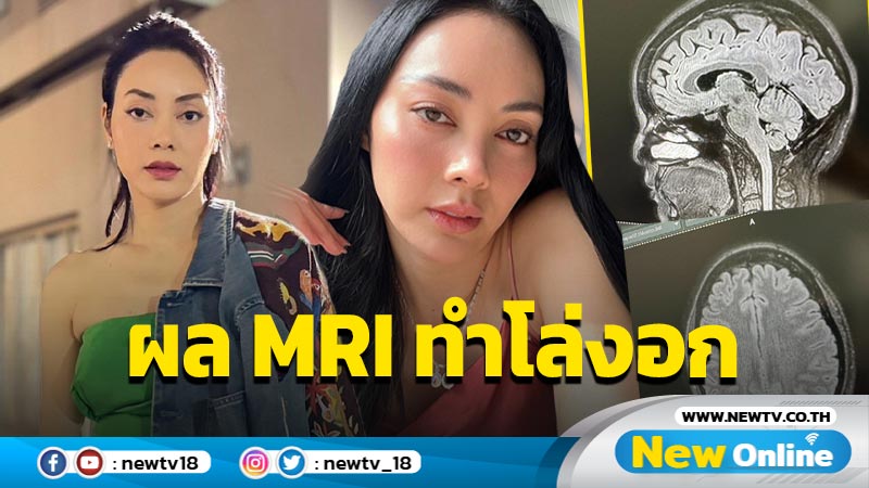 “ตั๊ก บงกช” โล่งอกผล MRI สมองเป็นแค่ไมเกรน หลังลุ้นแทบตายนึกว่าเป็นเนื้องอก !