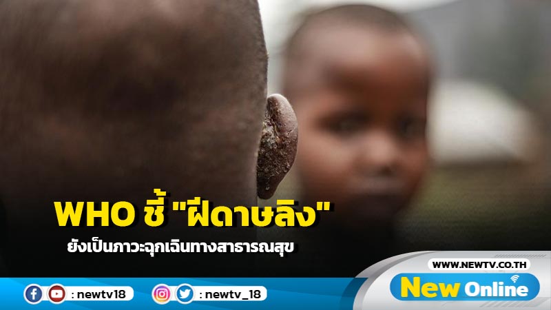 WHO ชี้ "ฝีดาษลิง" ยังเป็นภาวะฉุกเฉินทางสาธารณสุข